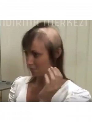 Protez Saç Uygulama 6